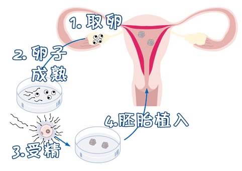 多囊卵巢案例